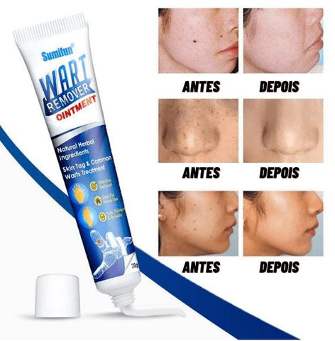 Gel Removedor De Verrugas Trendnatural  – Fim das Verrugas Sem Dor