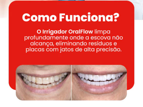 Oralflow Max + Kit De Acessórios Grátis! – Dentes Sempre Limpos